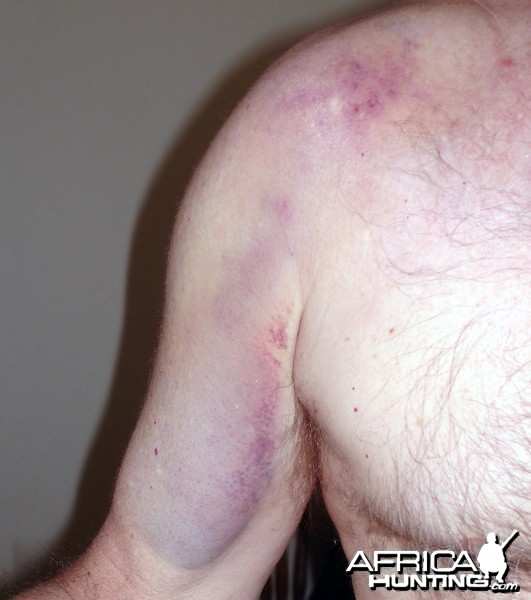 Shoulder bruise