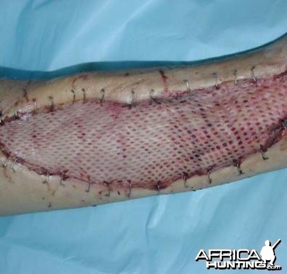 Puff Adder Bite