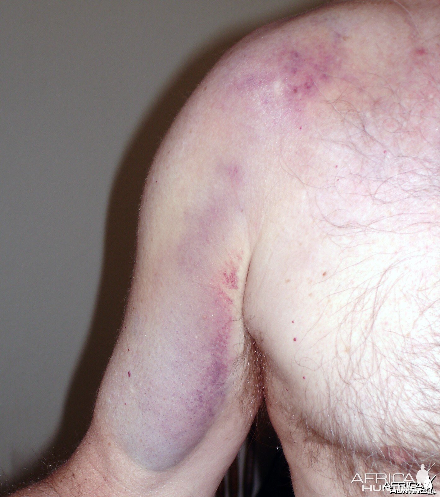 Shoulder bruise