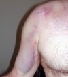 shoulder_bruise.jpg