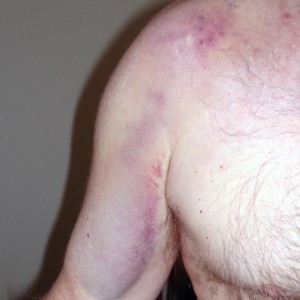 Shoulder bruise