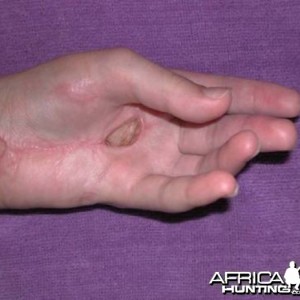 Puff Adder Bite