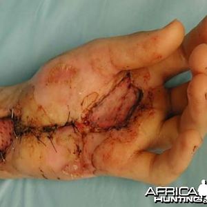 Puff Adder Bite