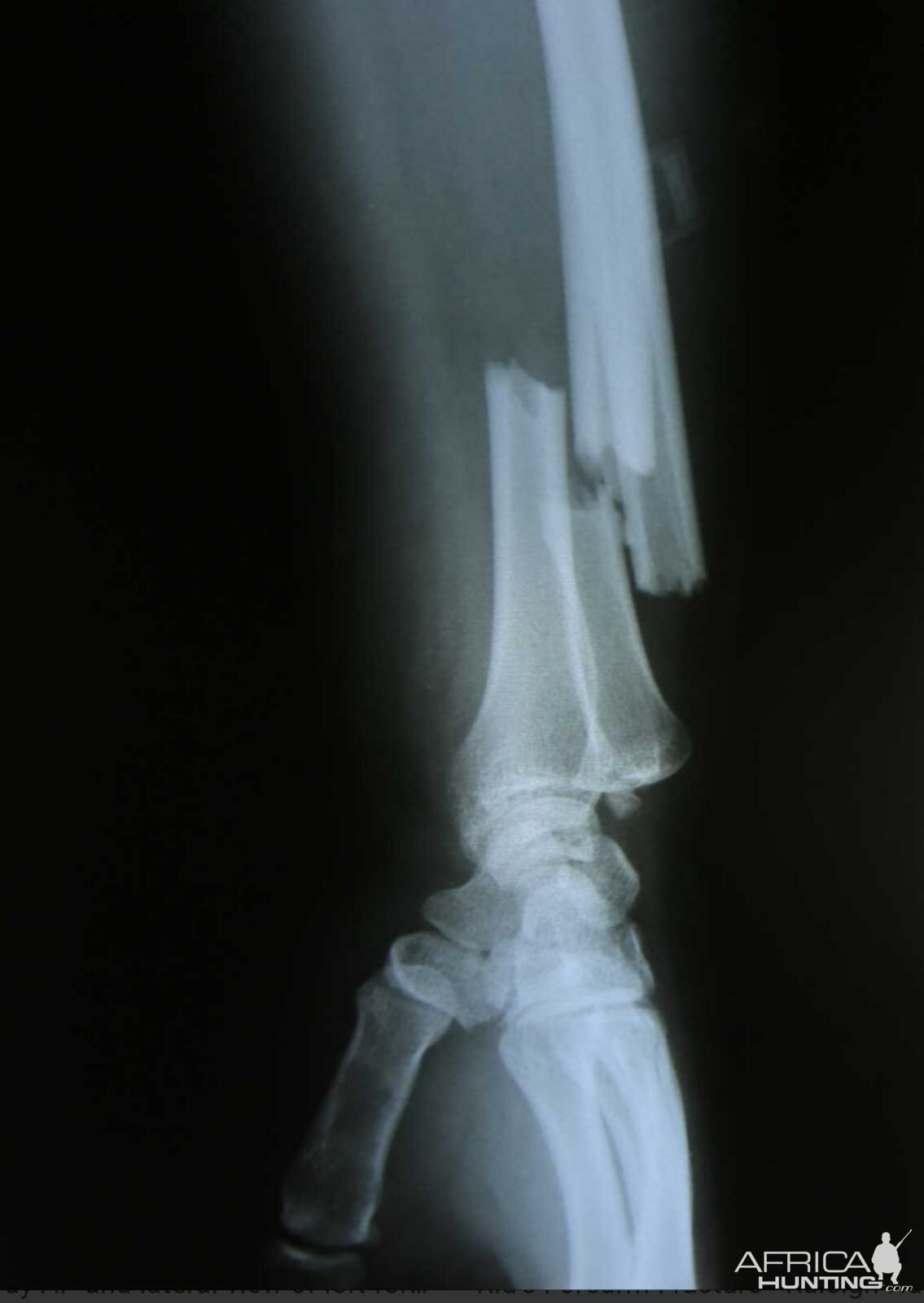 X ray plates of broken arm